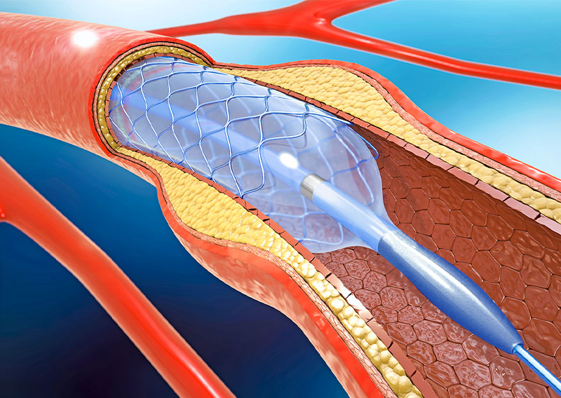 NC PTCA Balloon catheter